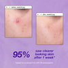 ClearStart Breakout Liquid Peel